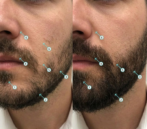 Viareline Spectral Men's™ Nanoxidil al 5%